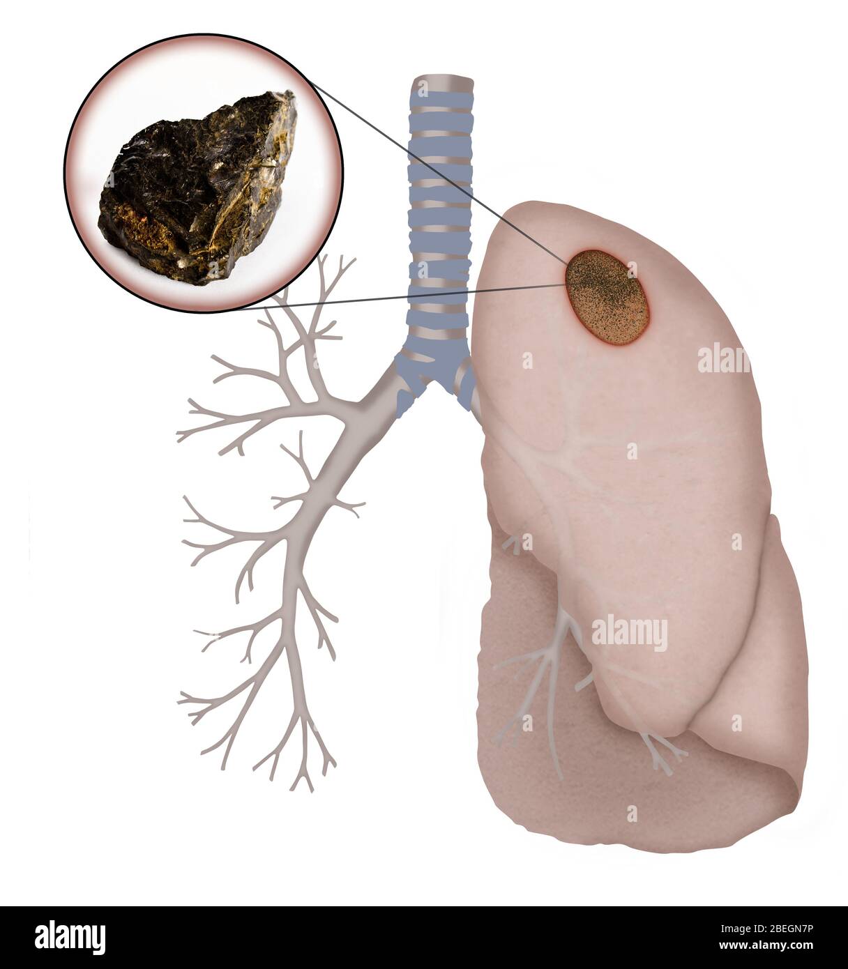 Polmone nero Foto Stock