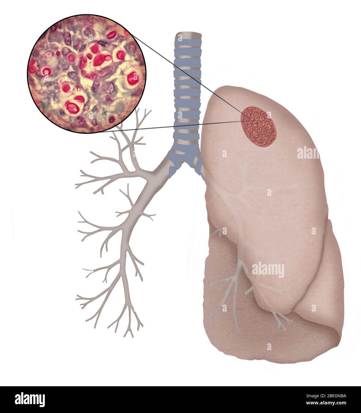 Cryptococcosis Foto Stock