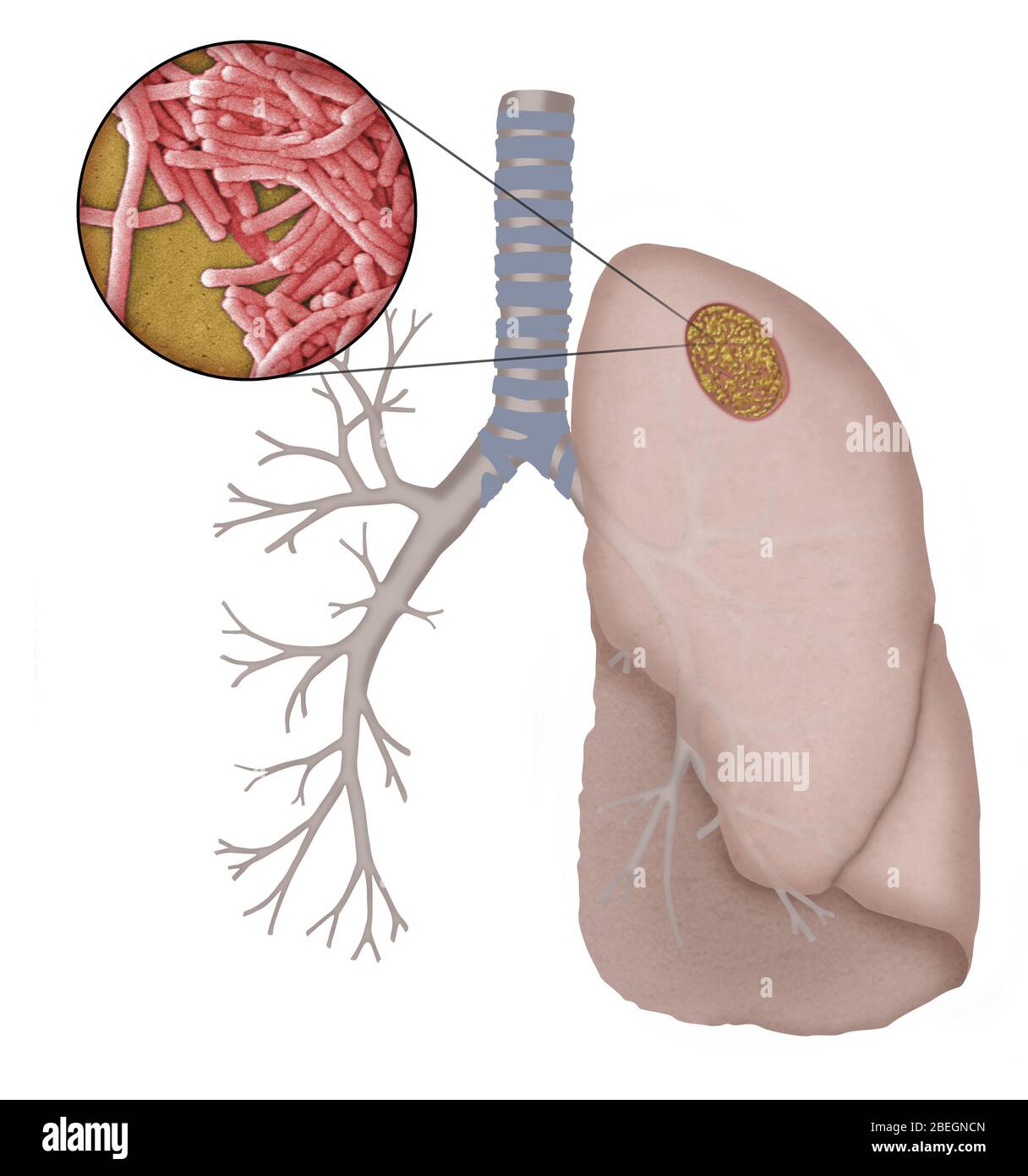 Malattia di Legionnaire Foto Stock