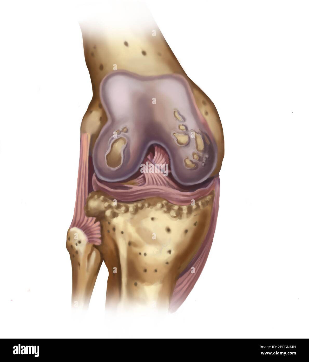 Osteoporosi del ginocchio Foto Stock
