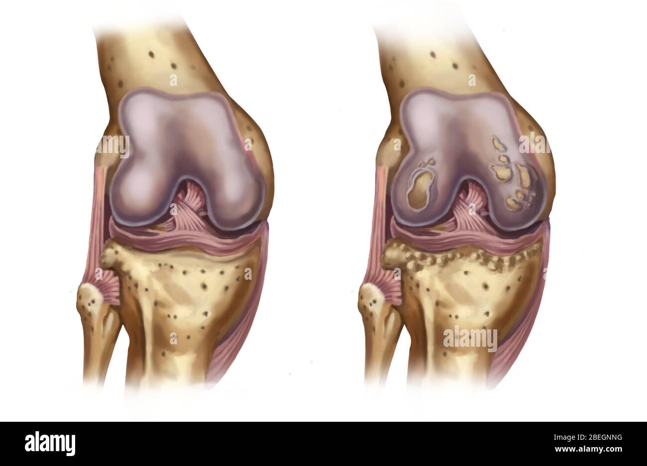 Osteoporosi del ginocchio Foto Stock