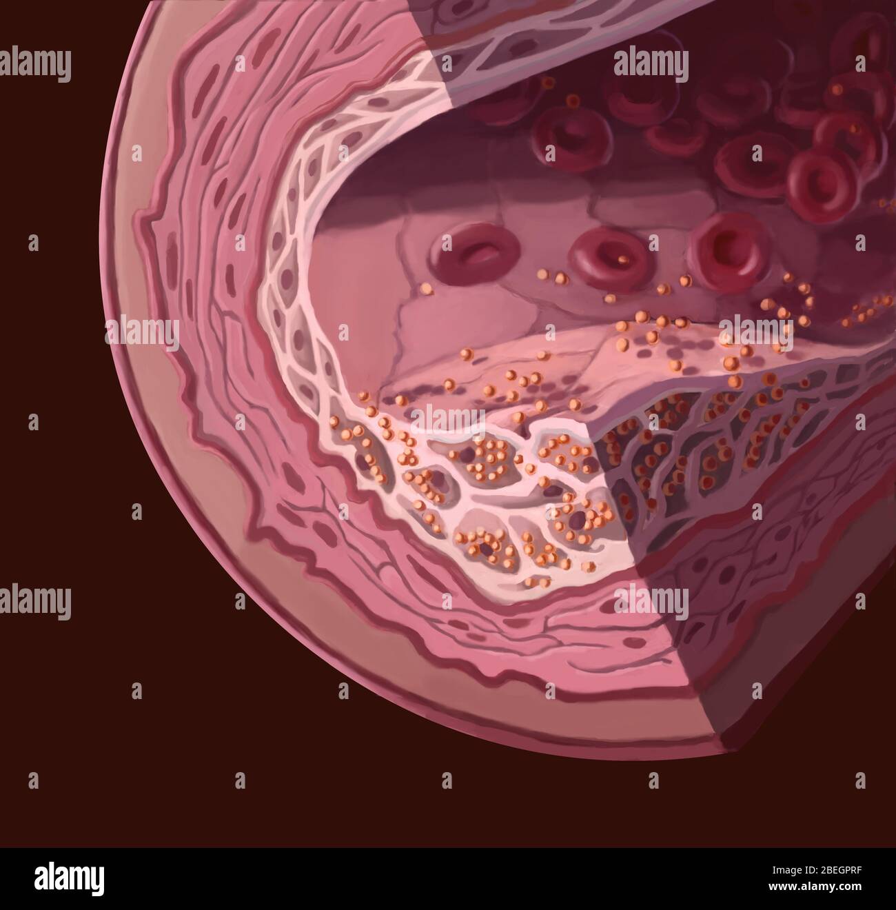 Colesterolo costruire, 1 di 3 Foto Stock