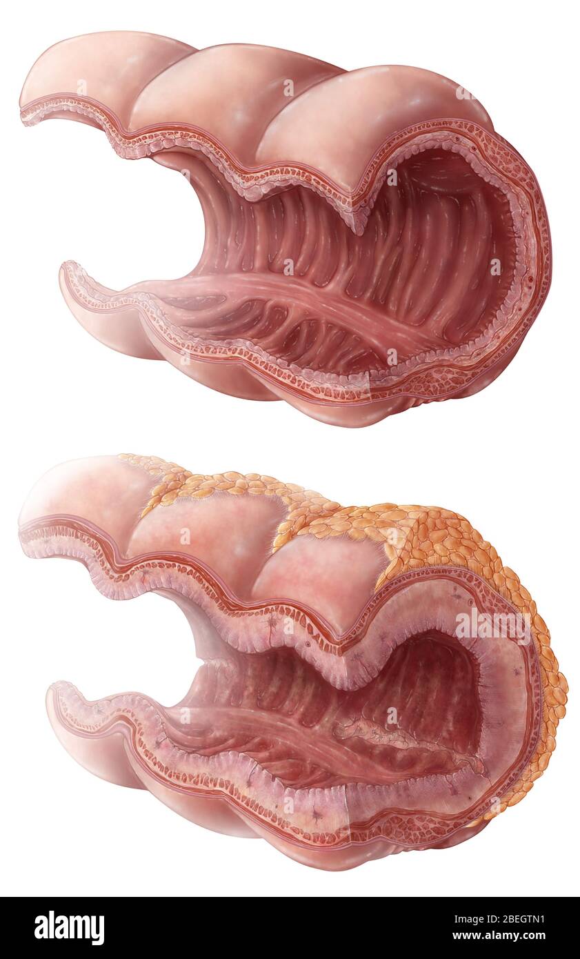 Progressione della malattia di Crohn Foto Stock