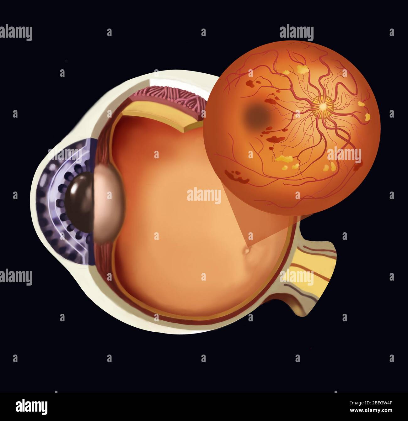 Retinopatia diabetica proliferativa Foto Stock