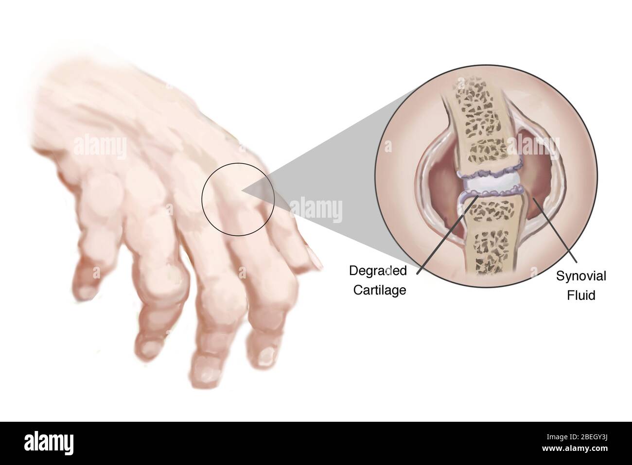 Artrite reumatoide Foto Stock