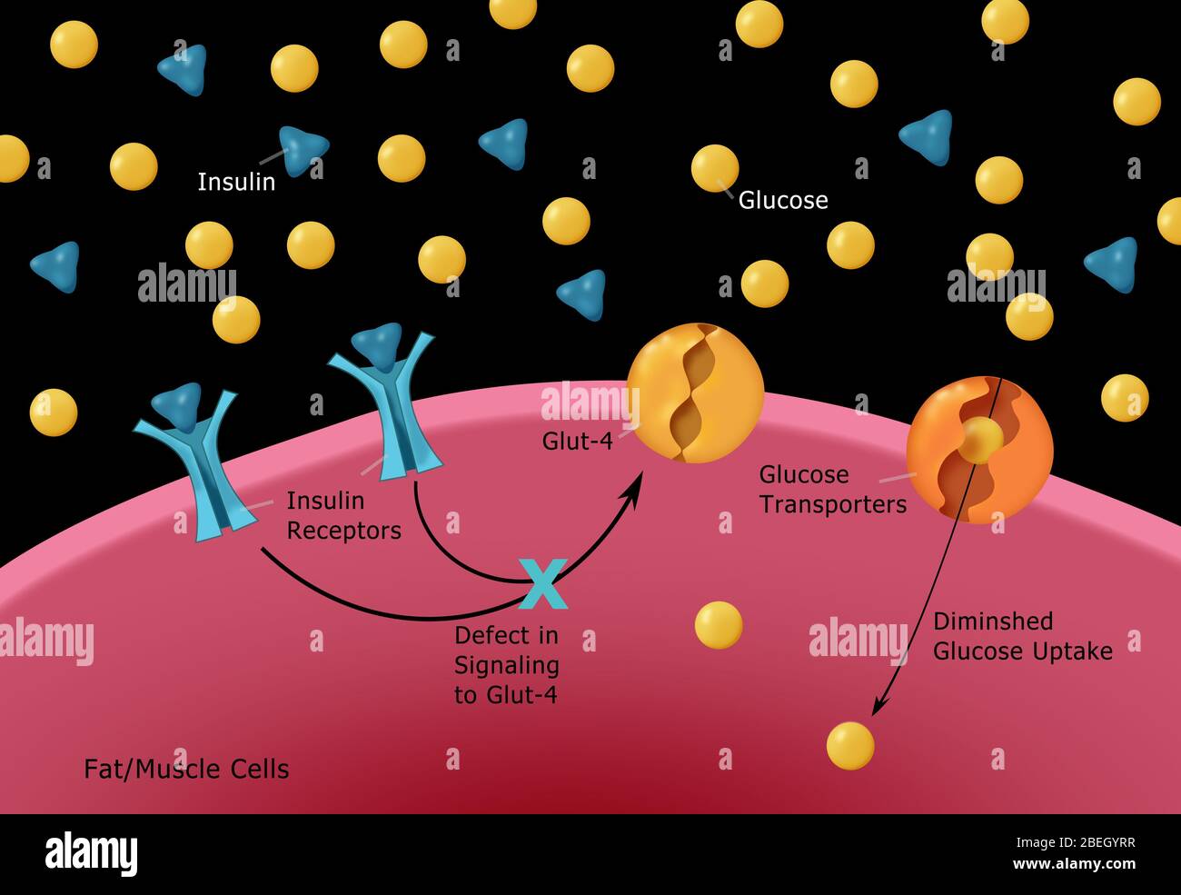 Diabete di tipo II Foto Stock