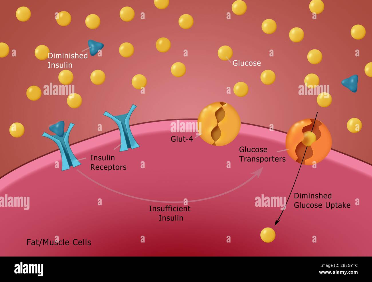 Diabete di tipo I. Foto Stock