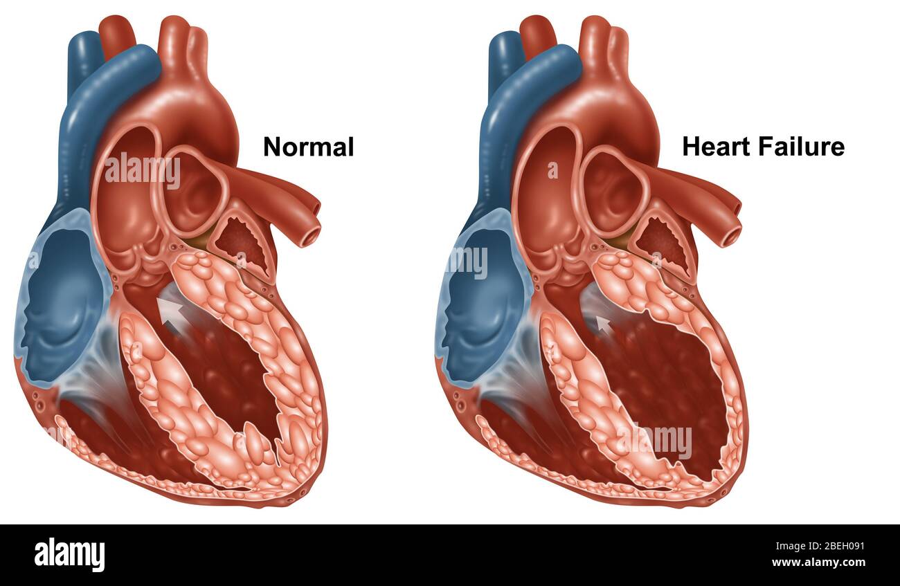 Cuori normali e malati Foto Stock