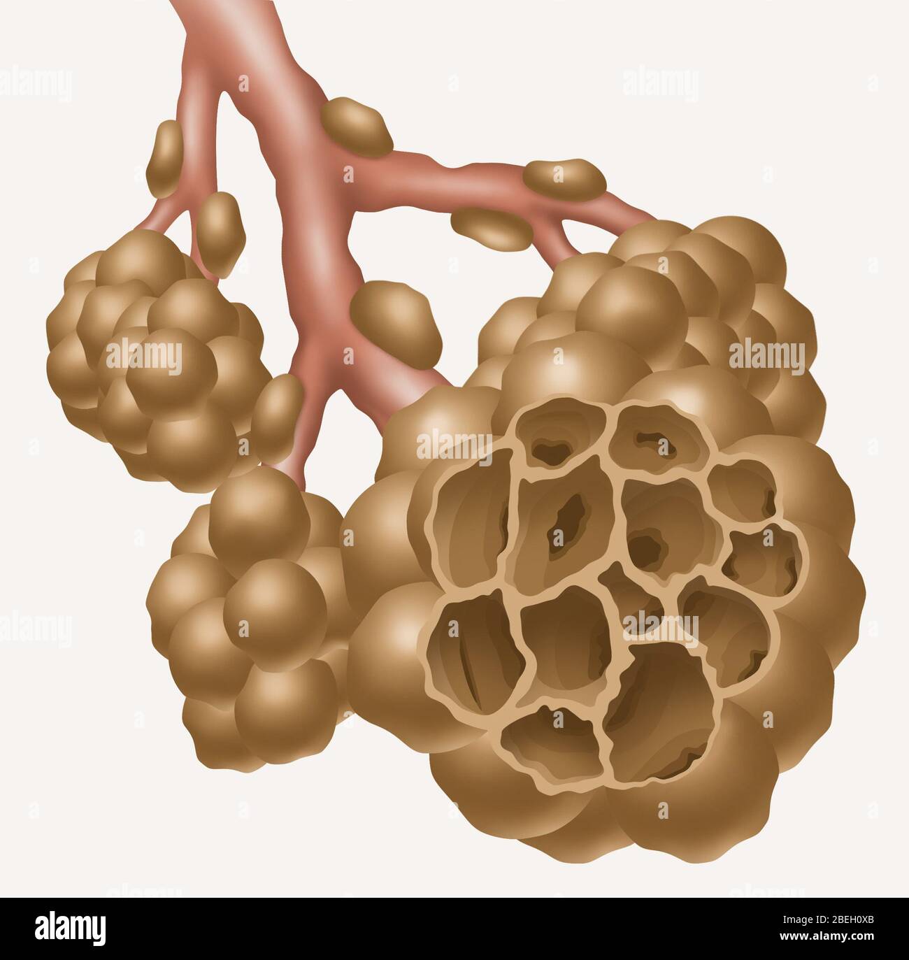 Alveoli con enfisema Foto Stock