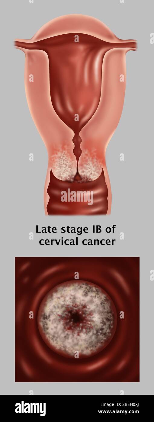 Tumore cervicale IB stadio tardivo Foto Stock