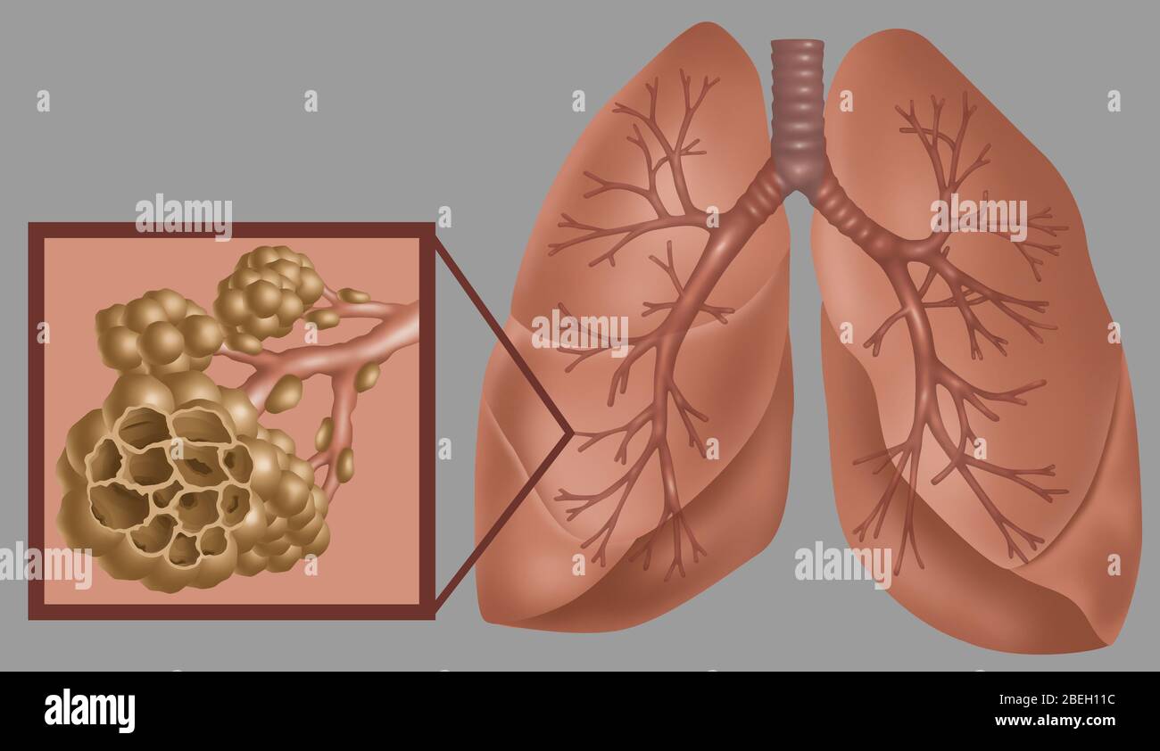 Polmoni e alveoli con enfisema Foto Stock
