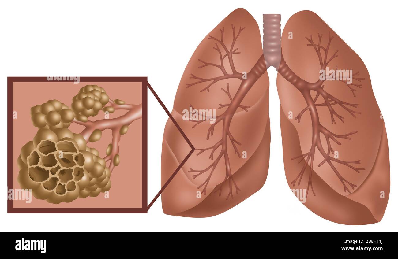 Modello Anatomico BPCO Malattia Polmonare GPI LFA #3110 - Per Studio E Formazione Medica