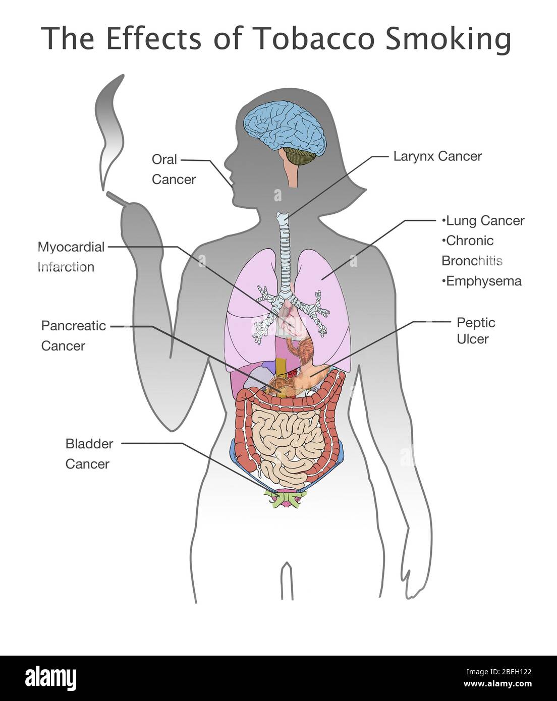 Effetti del fumo di tabacco Foto Stock