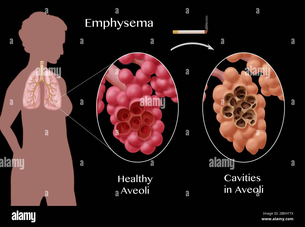 Confronto alveoli, enfisema Foto Stock