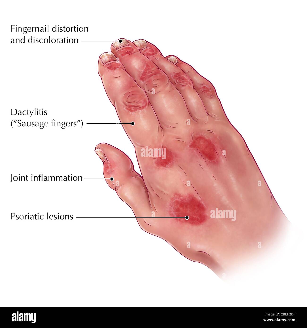 Artrite Psoriasica Foto Stock