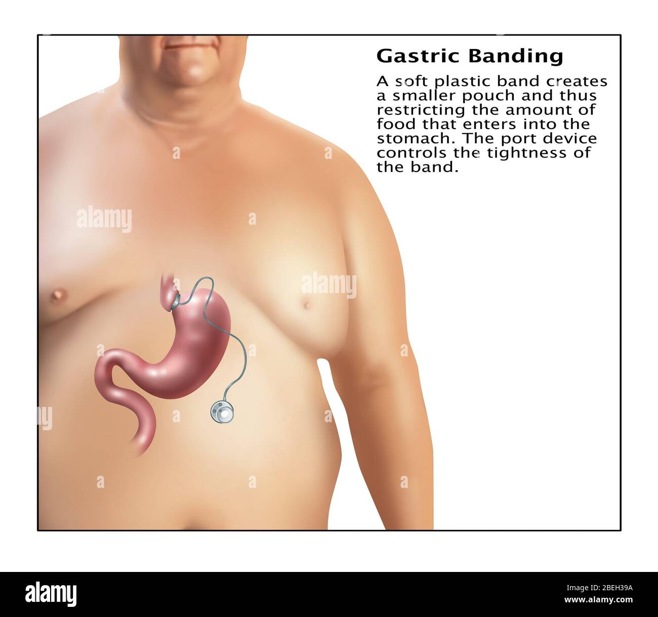 Illustrazione del bendaggio gastrico. Una chirurgia laparoscopica bendaggio gastrico regolabile, comunemente chiamato un lap-band, una banda o LAGB, è gonfiabile per un dispositivo di silicone posto attorno alla porzione superiore dello stomaco per il trattamento di obesità, destinati a rallentare il consumo di cibo e quindi ridurre la quantità di cibo consumato. Una morbida fascia in plastica crea una piccola sacca, limitando in tal modo la quantità di cibo che entra nello stomaco. Il dispositivo porta comanda il serraggio della fascetta. Foto Stock