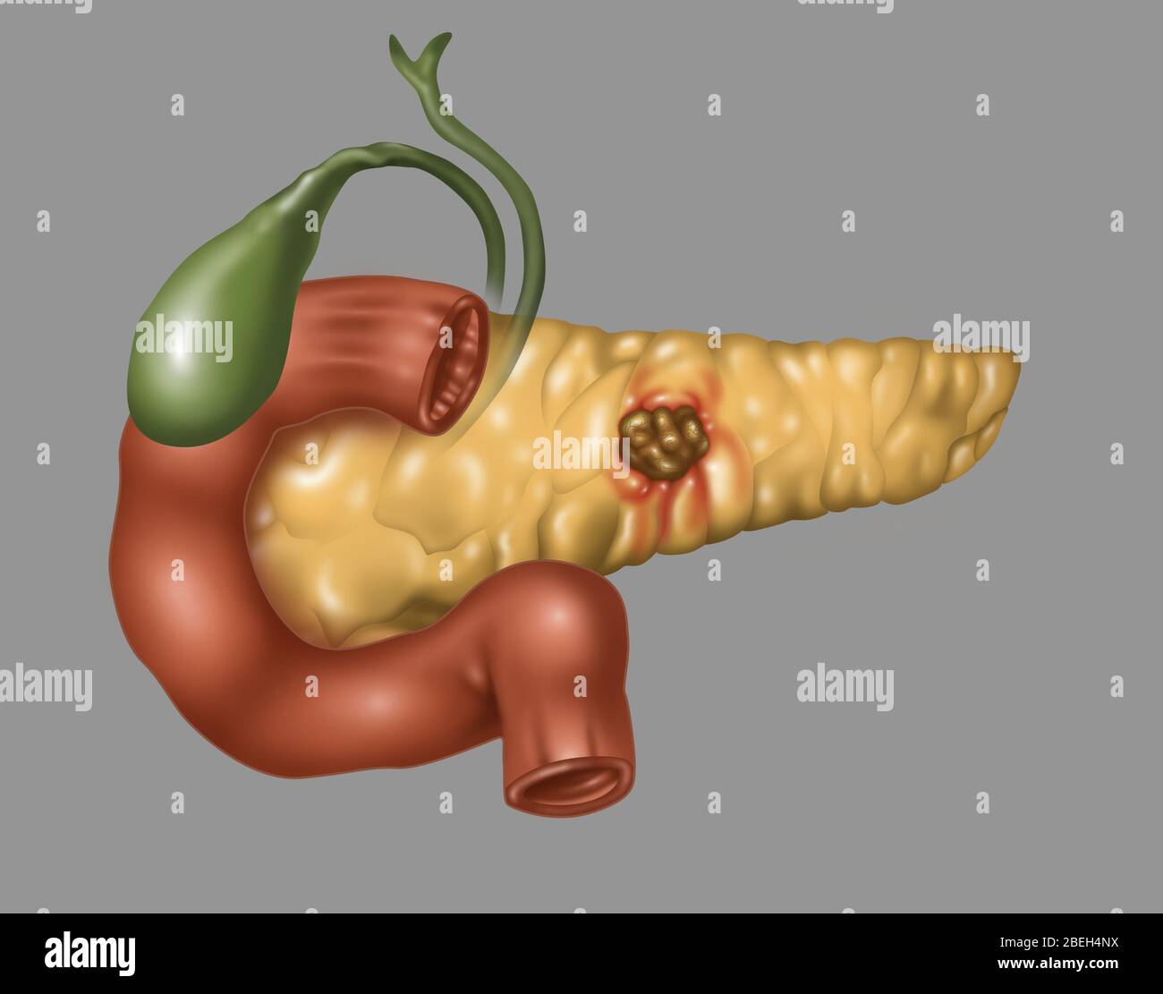Cancro pancreatico, illustrazione Foto Stock