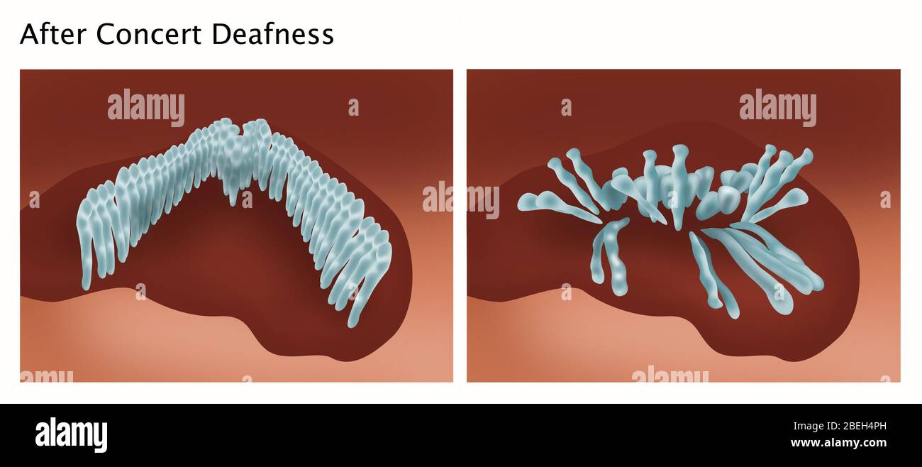 Perdita uditiva indotta dal rumore Foto Stock