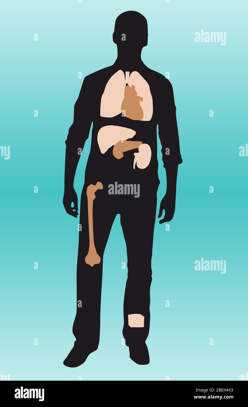 Organi mancanti nel corpo, illustrazione Foto Stock