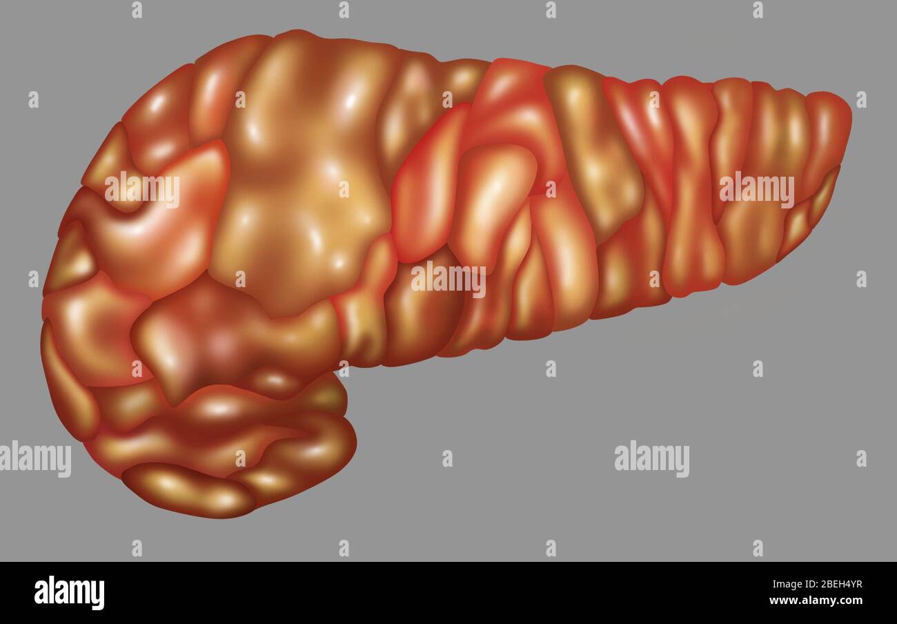 Infiammazione del pancreas, illustrazione Foto Stock