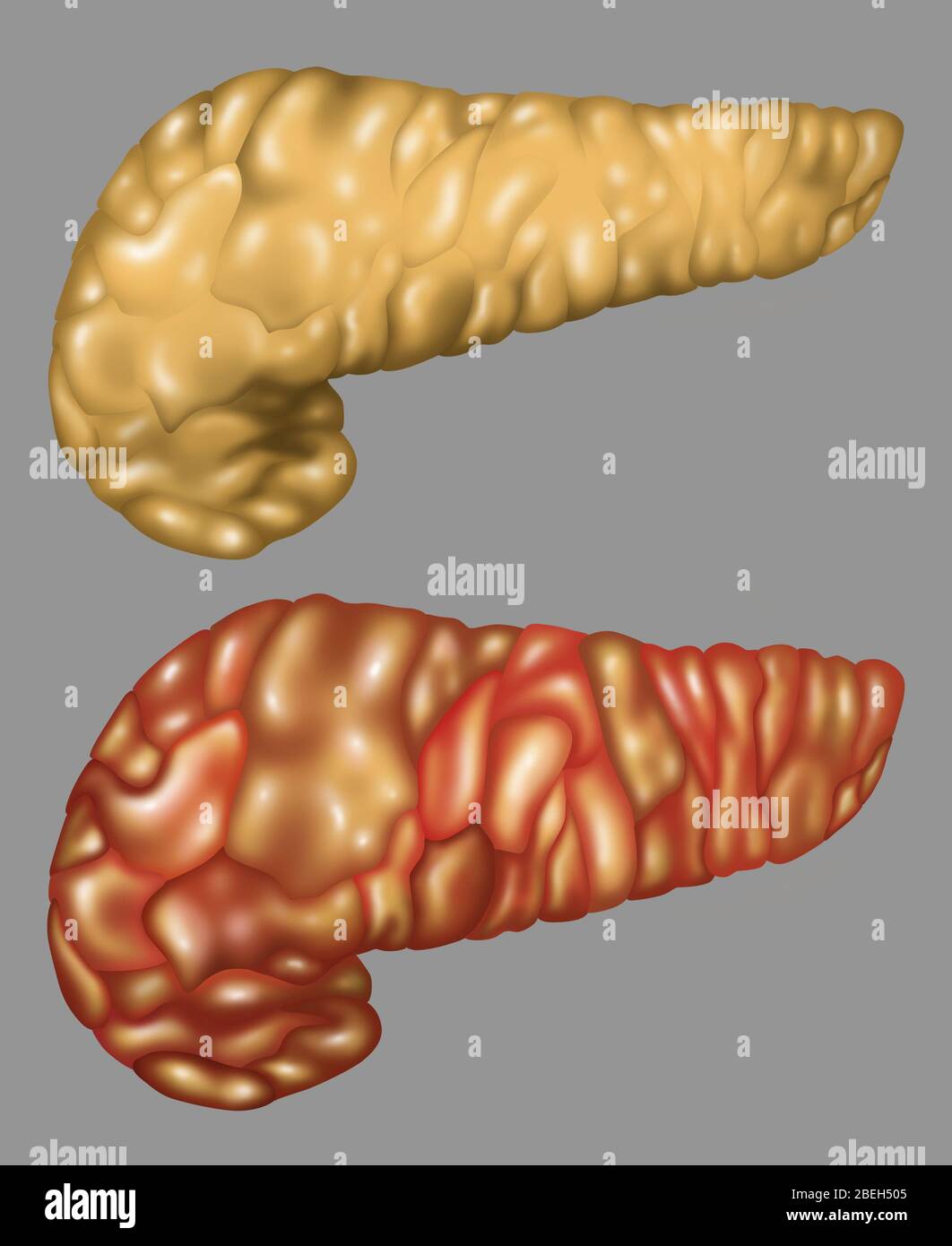 Pancreas illustrazione, sano e infiammato Foto Stock