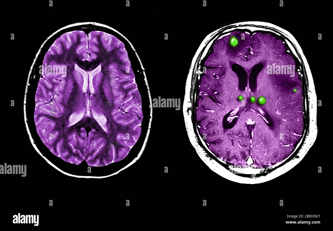 MRI di cervello normale e pieno di tumore Foto Stock