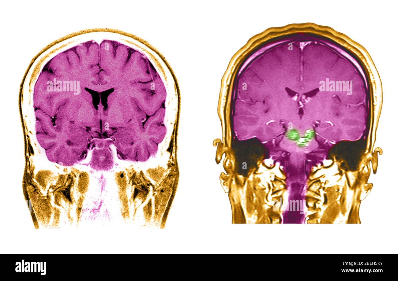 A sinistra è presente un'immagine MRI normale in sezione trasversale coronale (vista frontale) del cervello attraverso entrambi i lobi frontali ed entrambi i lobi temporali. A questo livello si vedono due cavità riempite con materiale scuro vicino al centro dell'immagine. Si tratta dei ventricoli laterali che sono riempiti di liquido vertebrale cerebrale (CSF). Esistono due tipi principali di tessuto cerebrale: La materia grigia (che contiene i corpi cellulari neuronali ed è la più scura del tessuto cerebrale mostrato) e la materia bianca (che è composta da fibre assonali). A destra è presente un'immagine MRI in sezione trasversale coronale (vista frontale) della testa che mostra la cavatrice Foto Stock