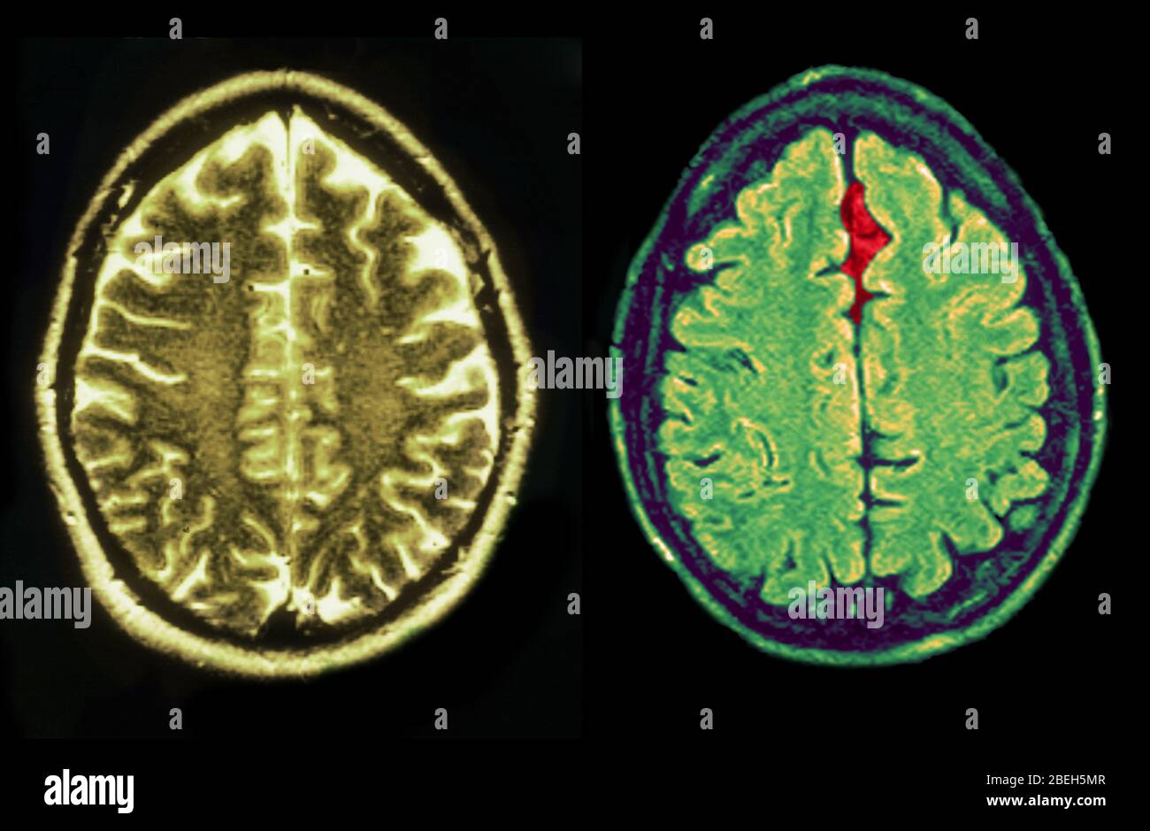 MRI di cervello normale e infortunato Foto Stock