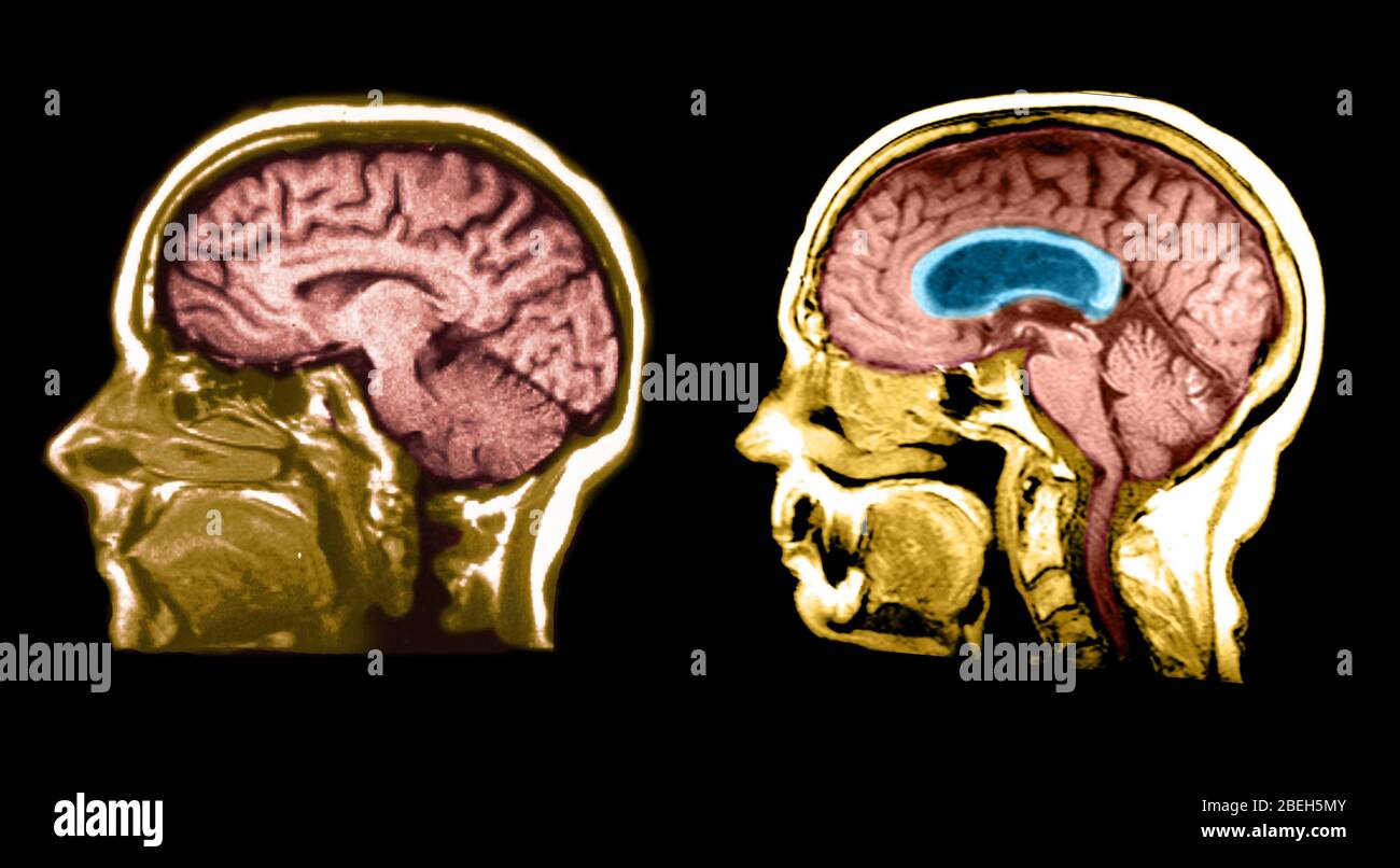 MRI del cervello normale e del cervello idrocefalo Foto Stock