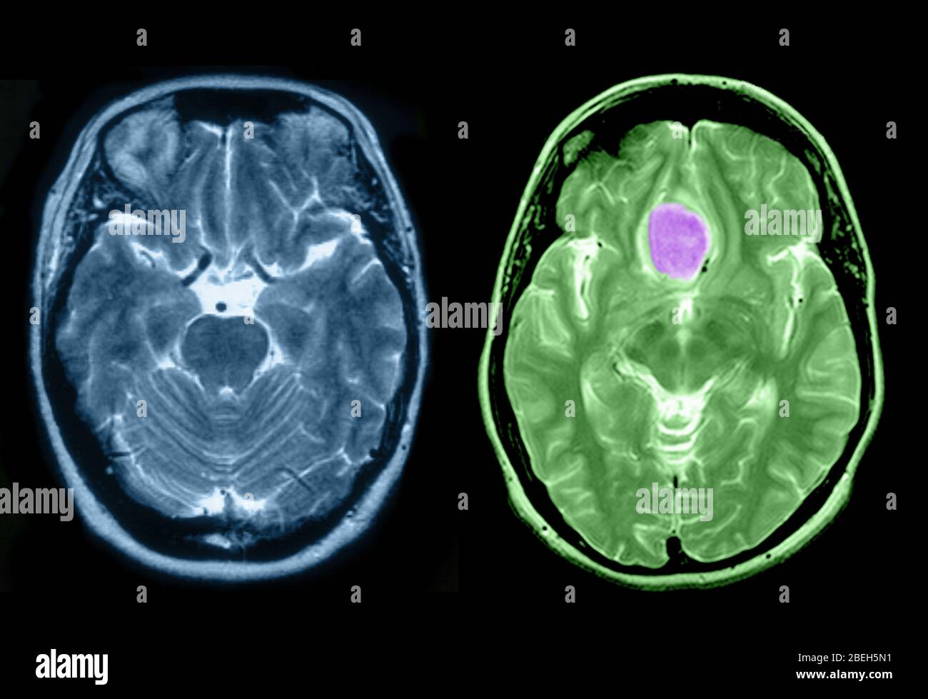 Cervello normale e meningioma Foto Stock