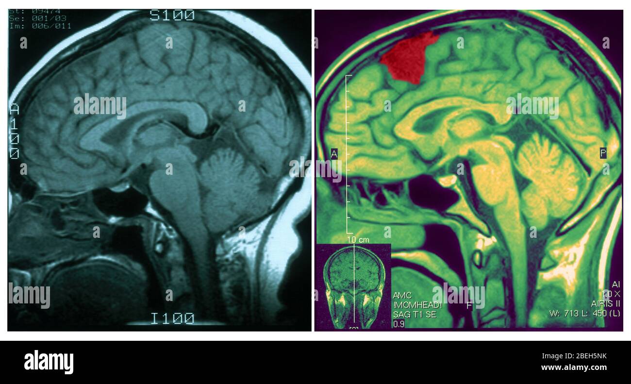 MRI di cervello normale e infortunato Foto Stock