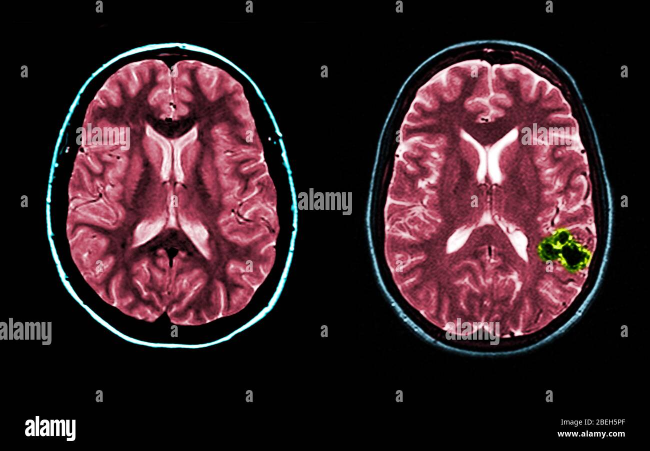 MRI dei cervelli normale e AVM Foto Stock