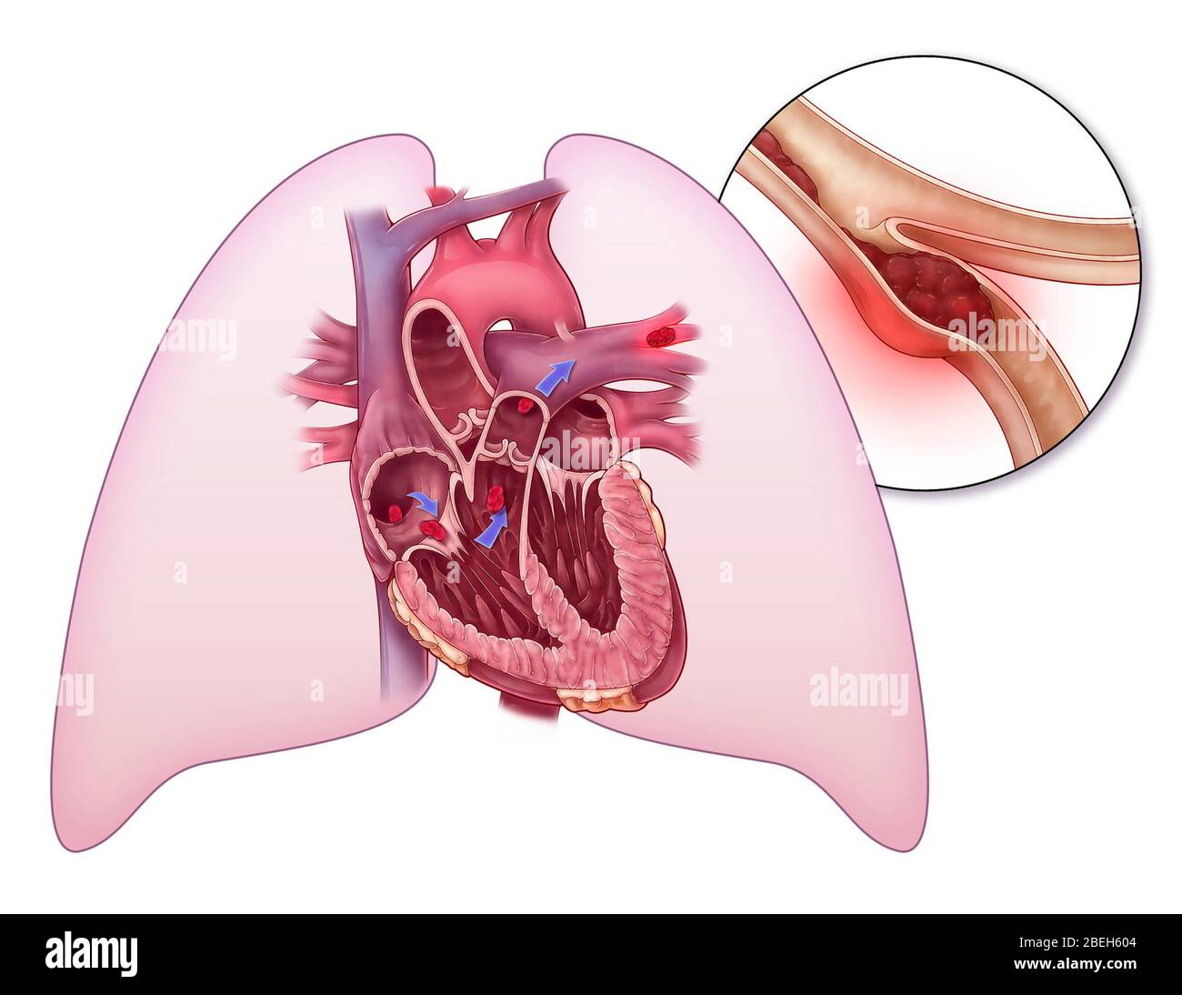 Embolia polmonare, illustrazione Foto Stock