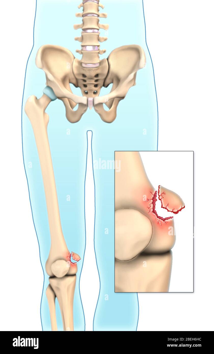 Frattura ossea di avulsione, illustrazione Foto Stock