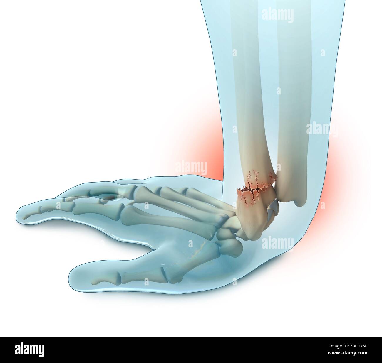 Where Is R Colles Colles fracture immagini e fotografie stock ad alta risoluzione - Alamy
