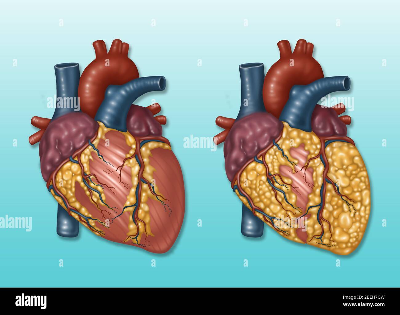 Cuore e arteria, normale vs temprato Foto Stock