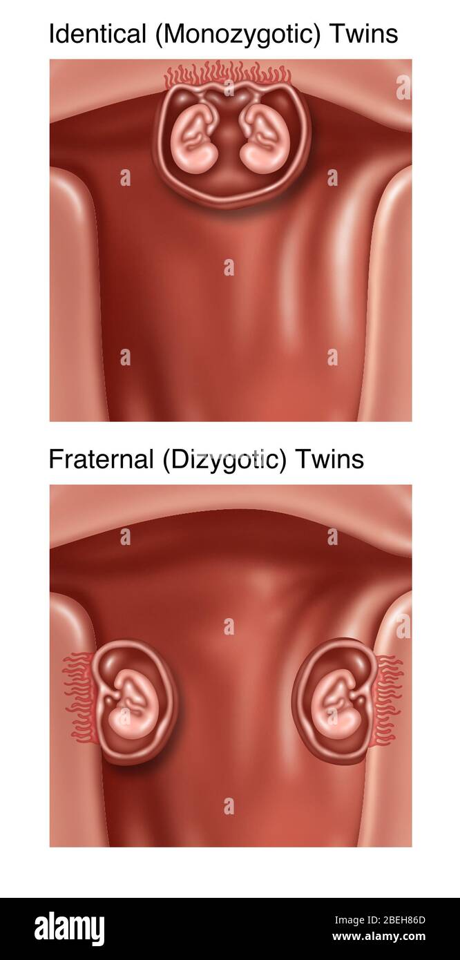 Sviluppo di Twins, illustrazione Foto Stock