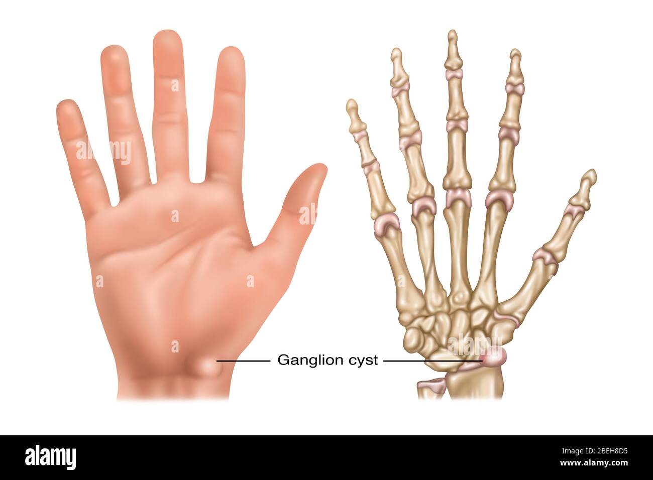 Ganglion cyst immagini e fotografie stock ad alta risoluzione - Alamy
