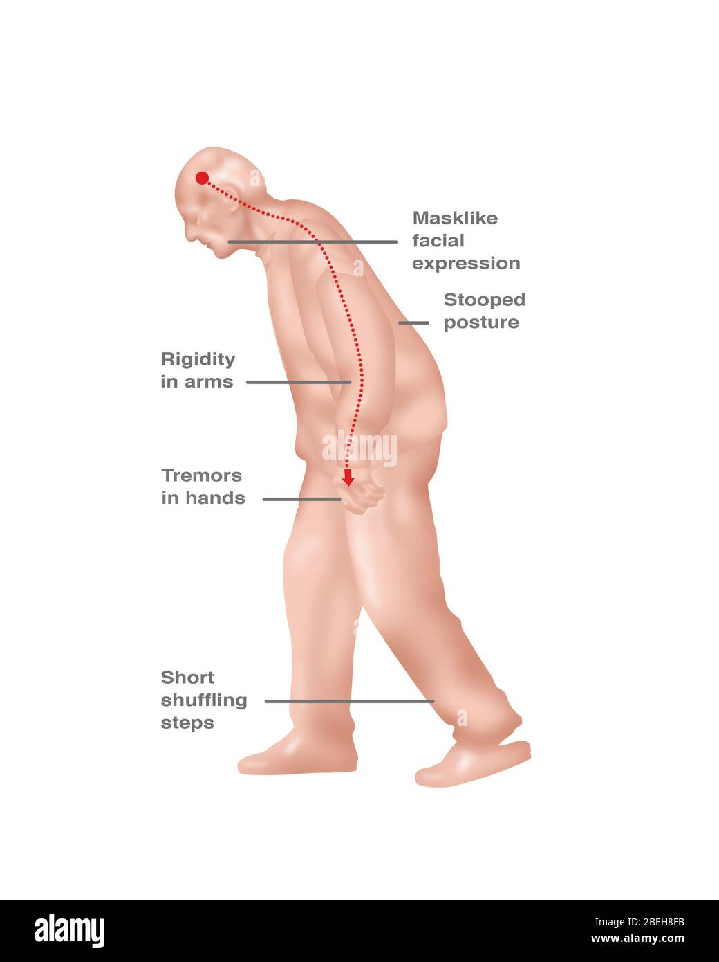 Sintomi del Parkinson, illustrazione Foto Stock