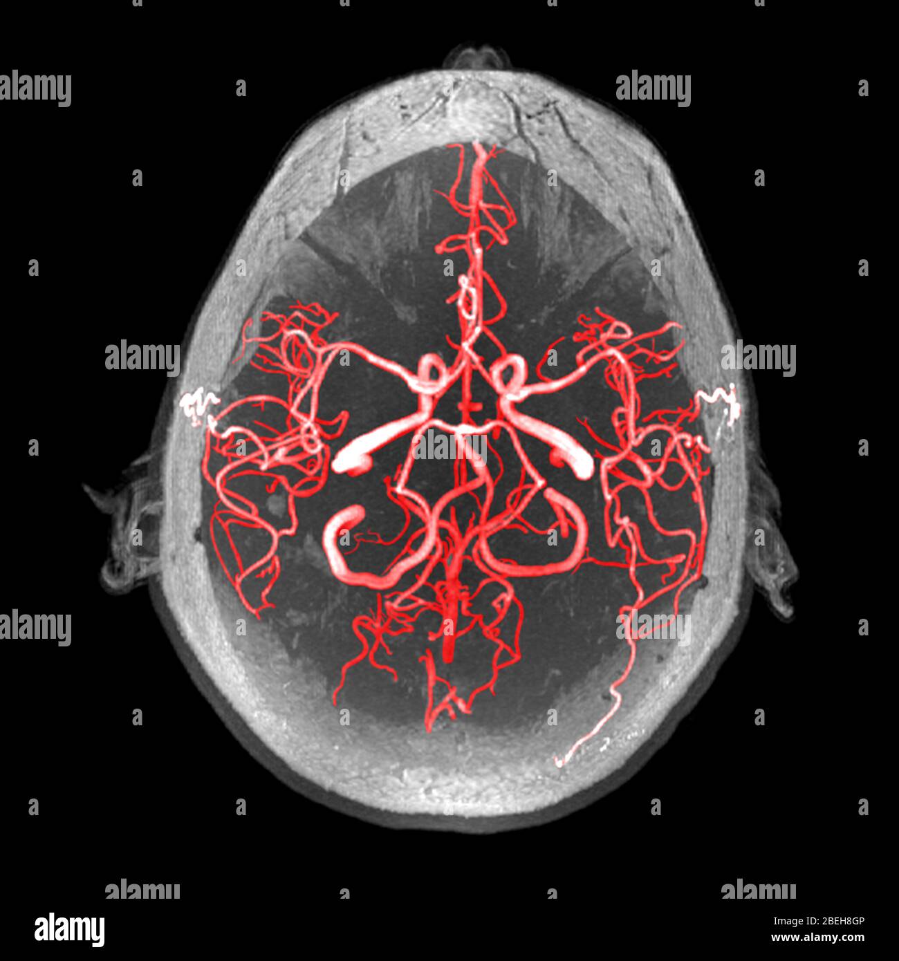 Arterie del cervello, MRA Foto Stock