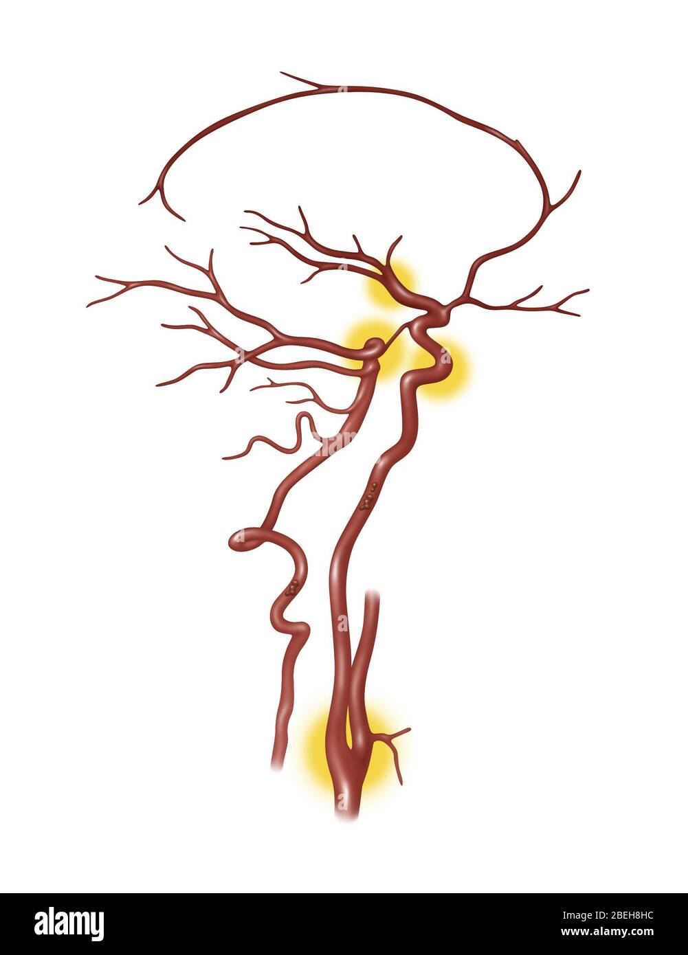 Arterie bloccate comuni, illustrazione Foto Stock