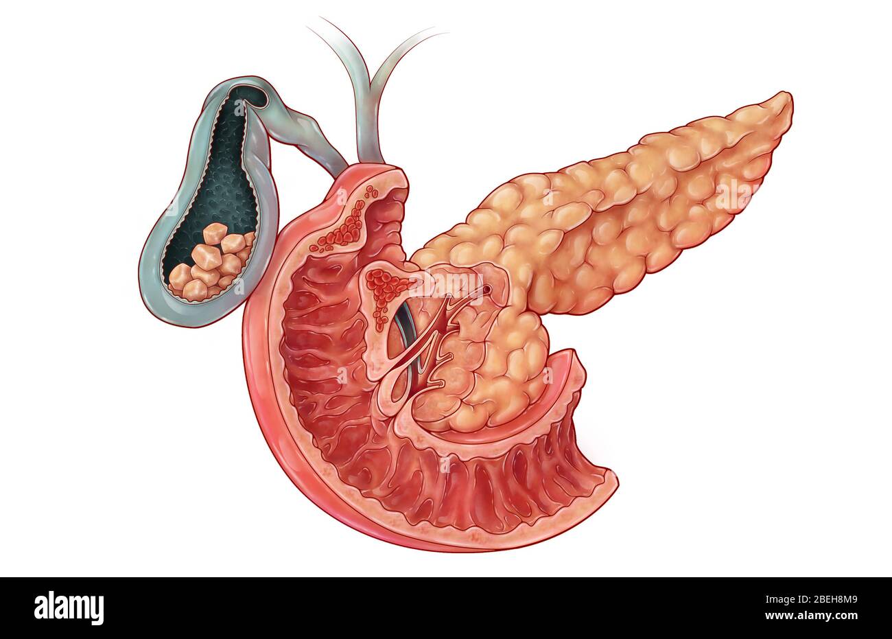 Calcoli biliari, illustrazione Foto Stock