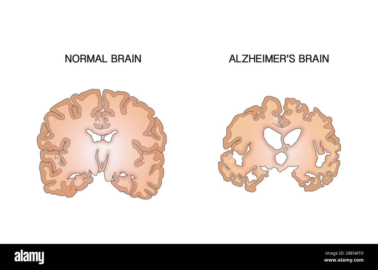 Alzheimer e cervello normale, confronto Foto Stock