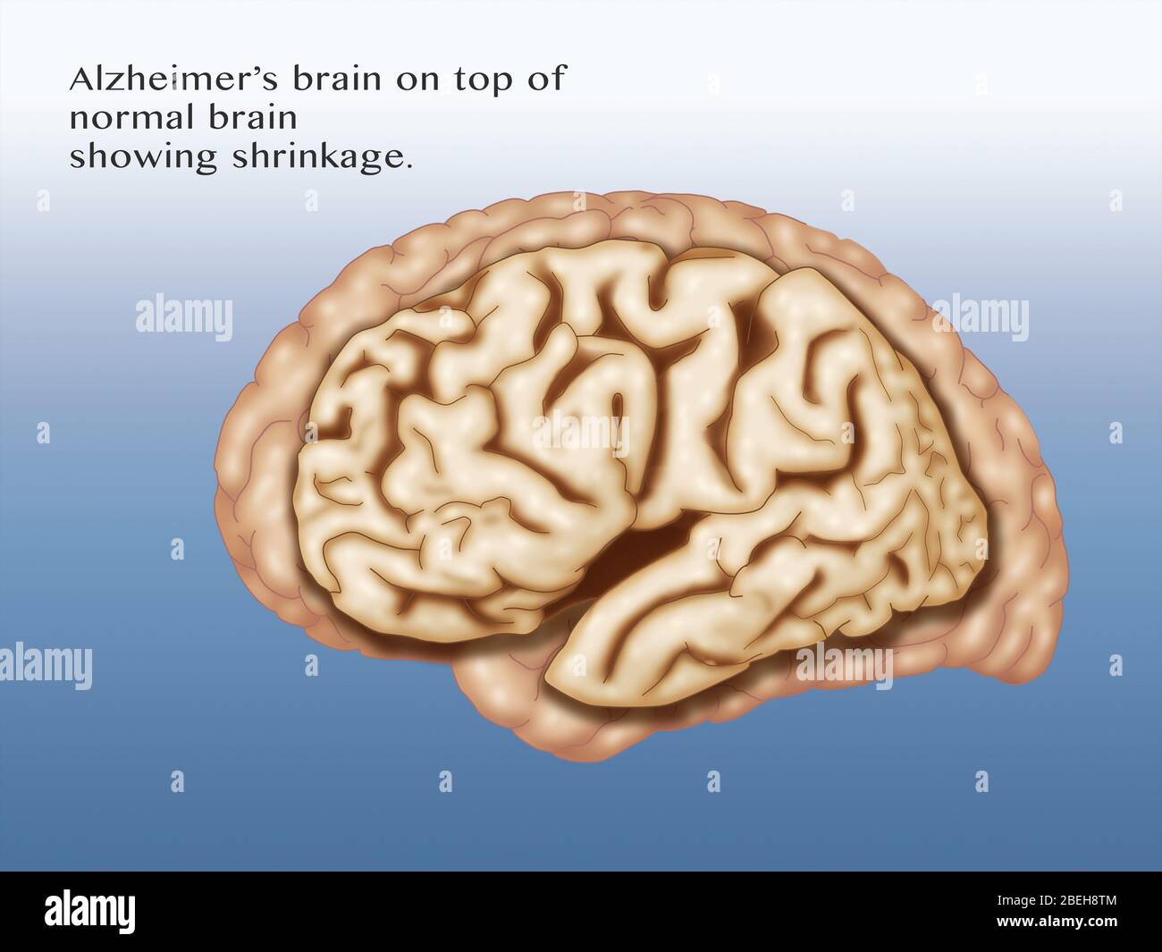 Alzheimer e cervello normale, confronto Foto Stock