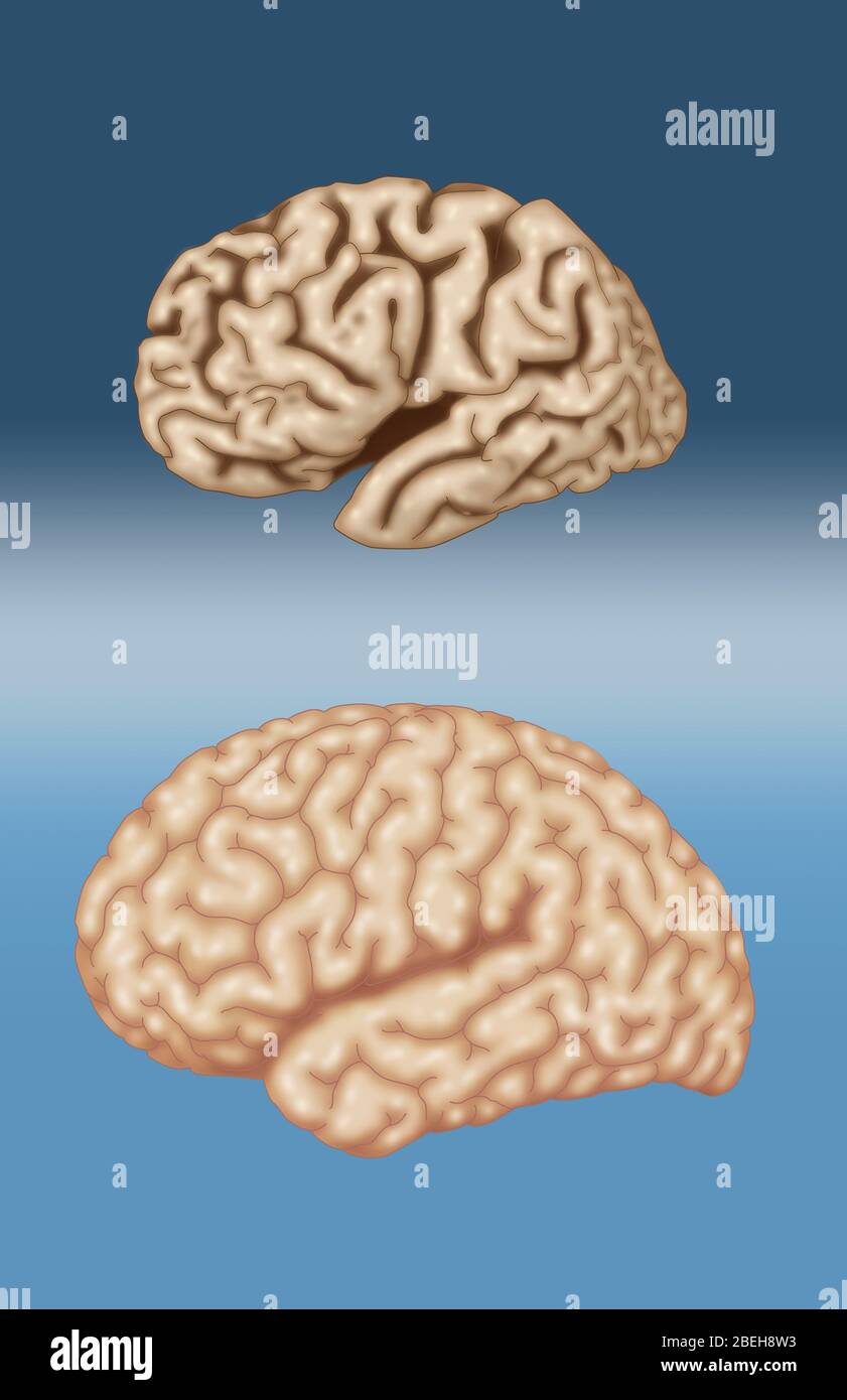 Alzheimer e cervello normale, confronto Foto Stock