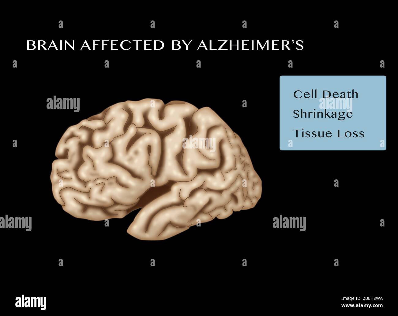 Cervello affetto dalla malattia di Alzheimer, caratterizzato da morte cellulare, ritiro e perdita di tessuto. Foto Stock