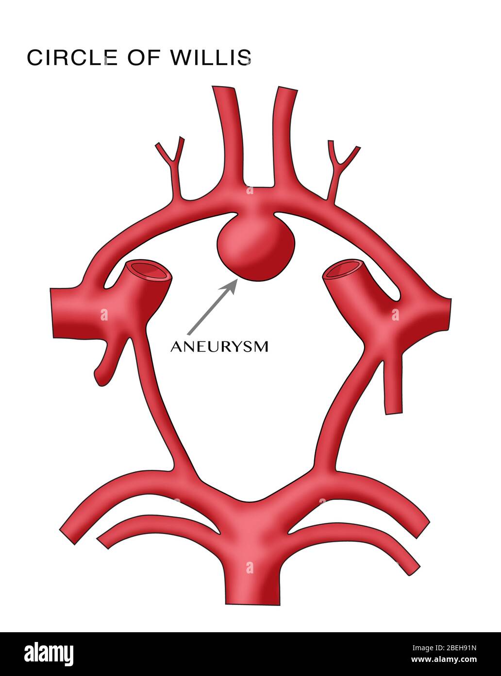 Aneurisma nel Circolo di Willis Foto Stock