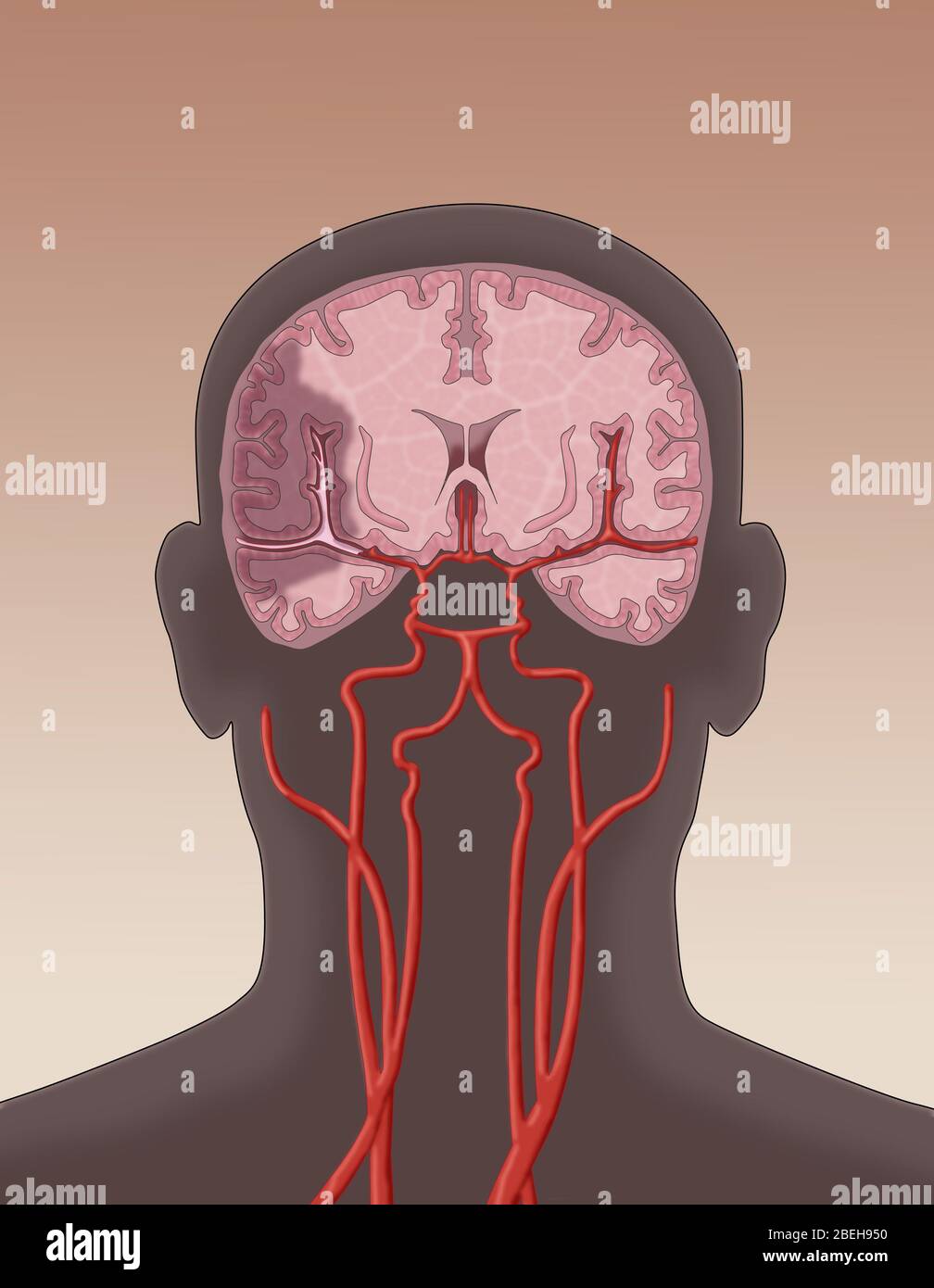 Ictus ischemico. In un ictus ischemico un coagulo blocca il flusso sanguigno verso un'area del cervello. Foto Stock