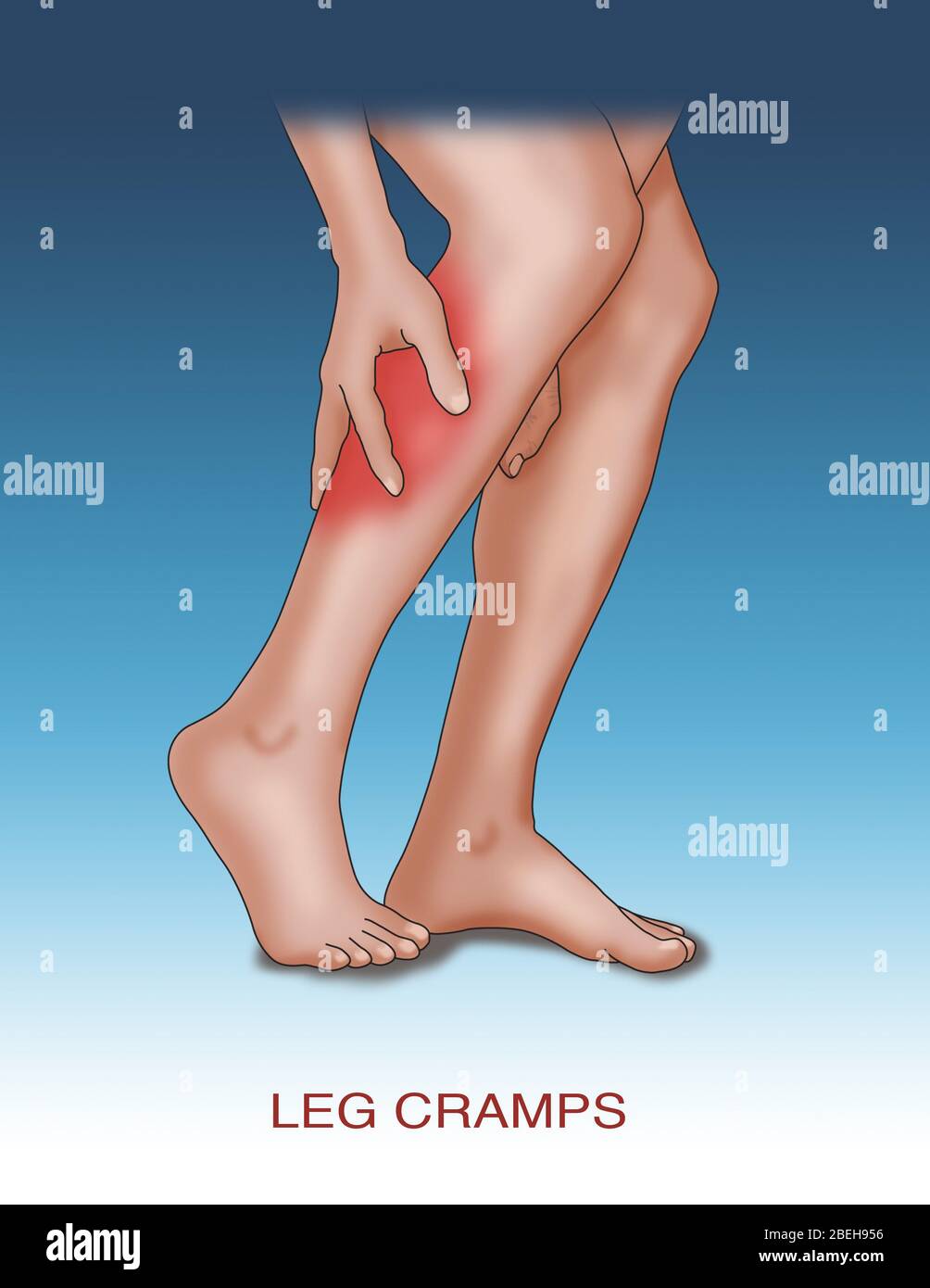 Crampi alle gambe cause comuni, illustrazione Foto Stock