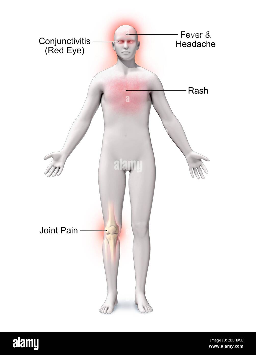 Febbre Zika, illustrazione Foto Stock